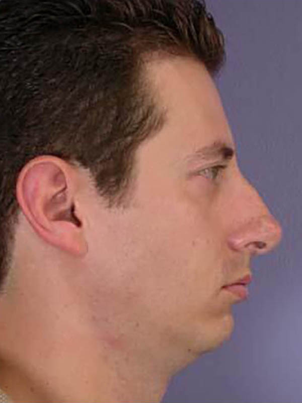 Chin & Cheek Shaping Before & After Image
