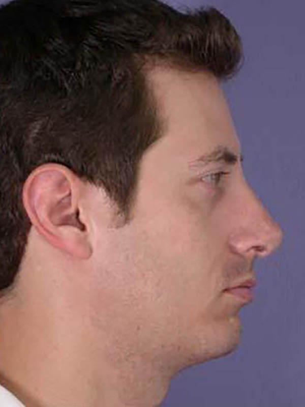 Chin & Cheek Shaping Before & After Image