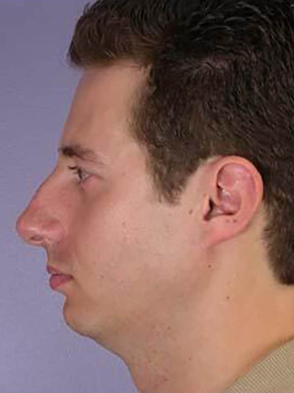 Chin & Cheek Shaping Before & After Image