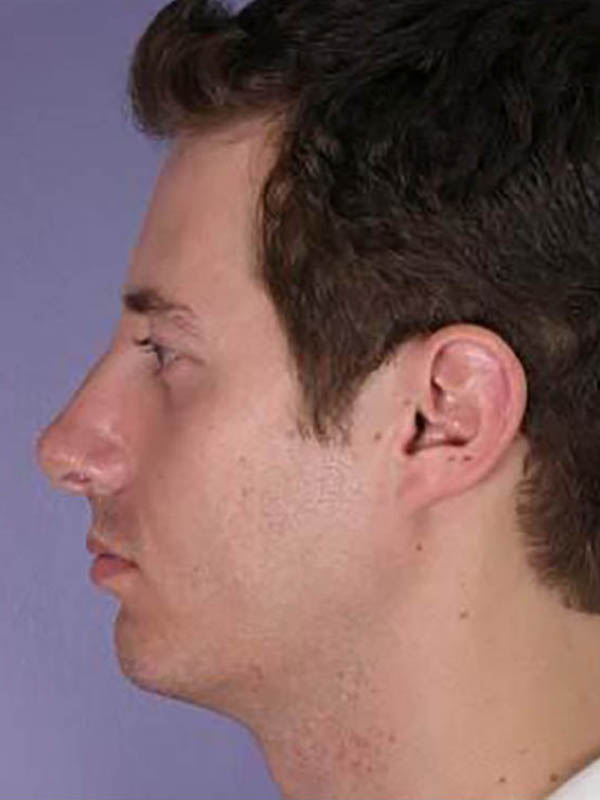 Chin & Cheek Shaping Before & After Image