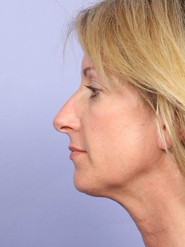 Chin & Cheek Shaping Before & After Image