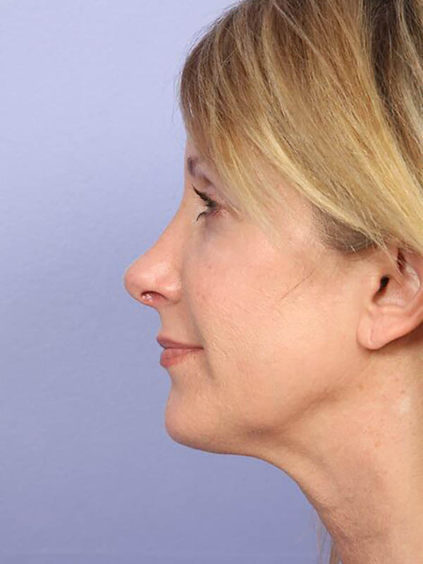 Chin & Cheek Shaping Before & After Image