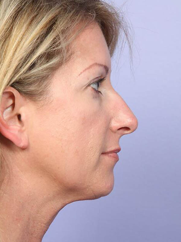 Chin & Cheek Shaping Before & After Image