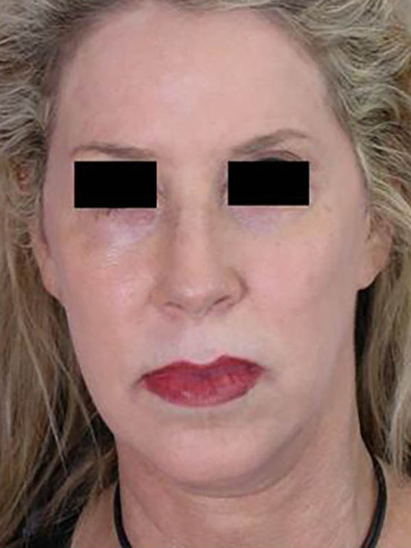 Chin & Cheek Shaping Before & After Image