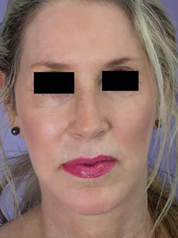 Chin & Cheek Shaping Before & After Image