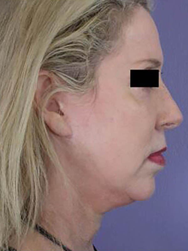 Chin & Cheek Shaping Before & After Image