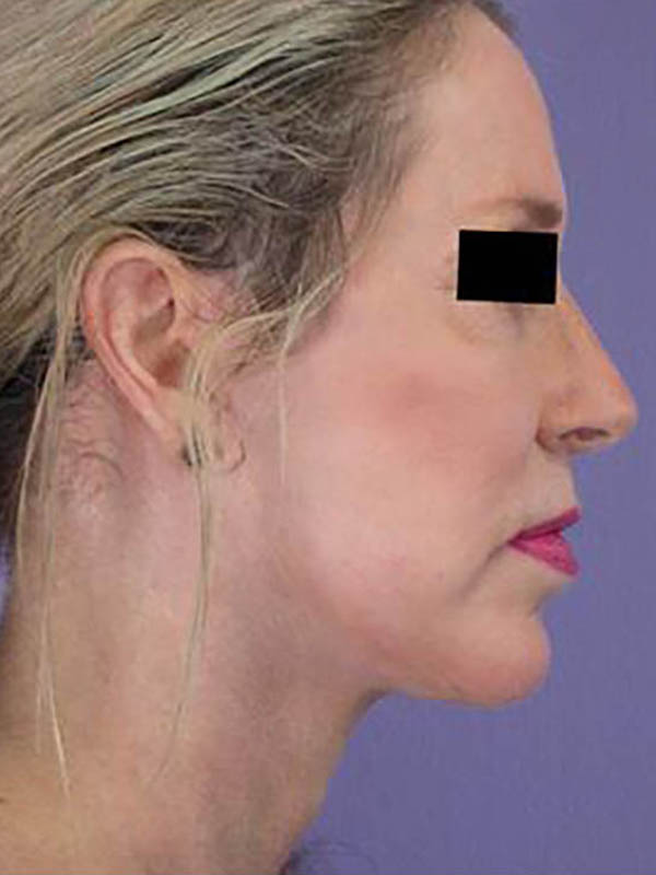 Chin & Cheek Shaping Before & After Image