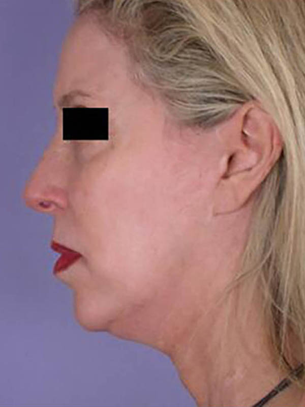 Chin & Cheek Shaping Before & After Image