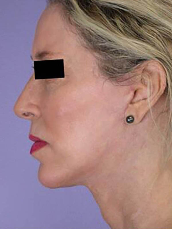 Chin & Cheek Shaping Before & After Image