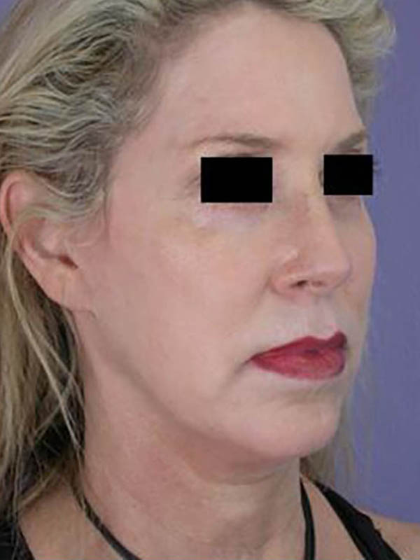 Chin & Cheek Shaping Before & After Image