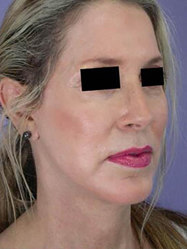 Chin & Cheek Shaping Before & After Image