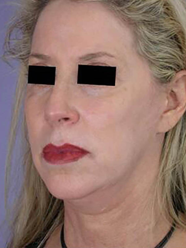 Chin & Cheek Shaping Before & After Image