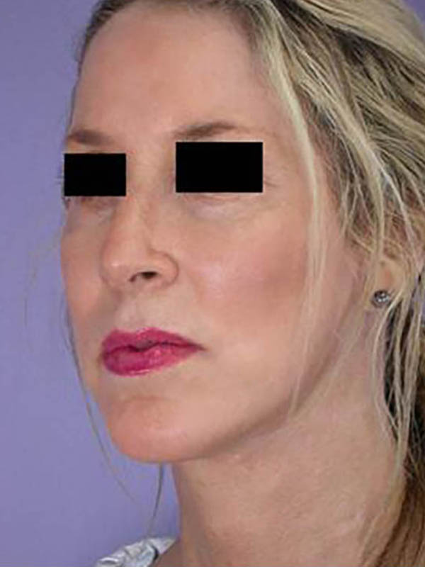 Chin & Cheek Shaping Before & After Image