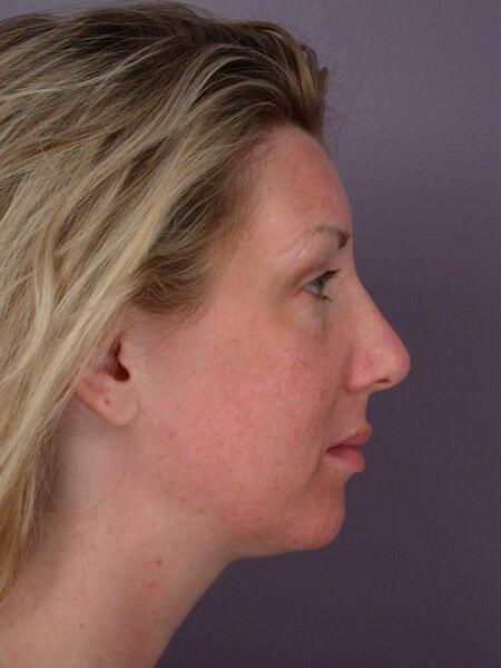 Chin & Cheek Shaping Before & After Image