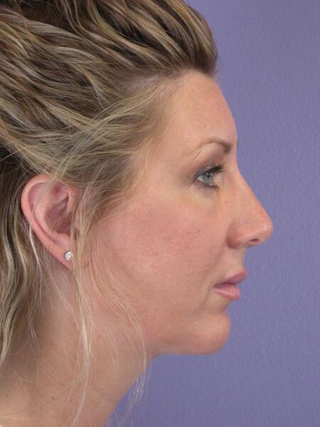 Chin & Cheek Shaping Before & After Image