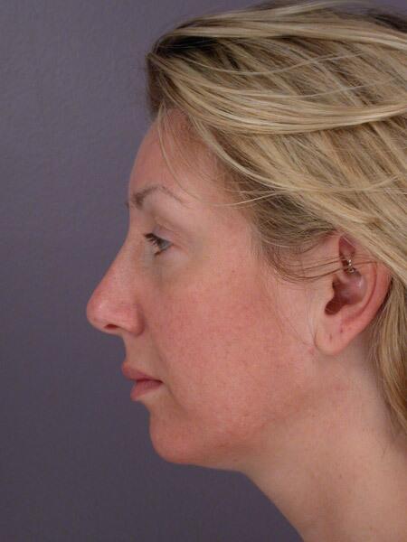 Chin & Cheek Shaping Before & After Image