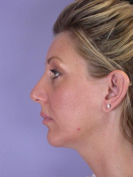 Chin & Cheek Shaping Before & After Image