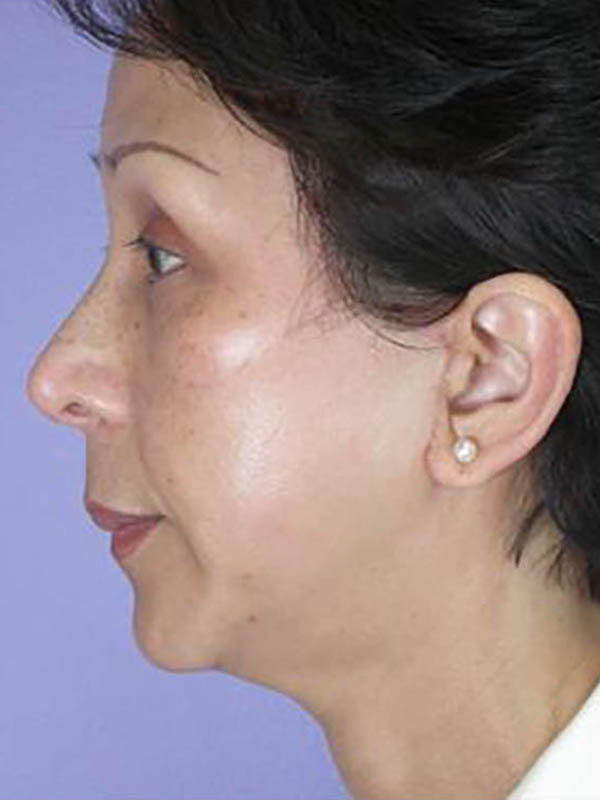 Chin & Cheek Shaping Before & After Image