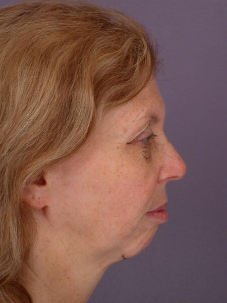 Chin & Cheek Shaping Before & After Image