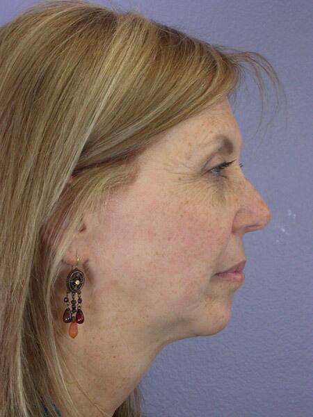 Chin & Cheek Shaping Before & After Image