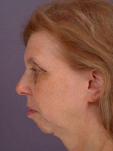 Chin & Cheek Shaping Before & After Image