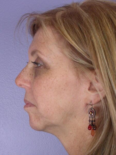 Chin & Cheek Shaping Before & After Image