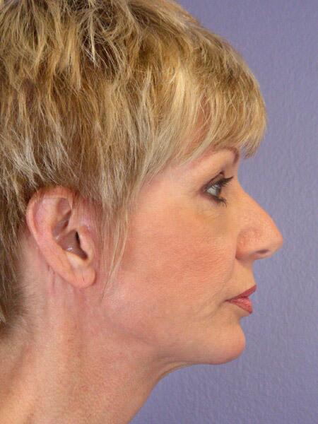 Chin & Cheek Shaping Before & After Image