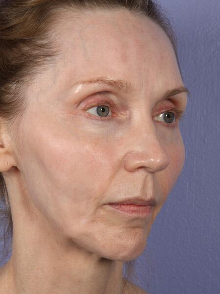 Chin & Cheek Shaping Before & After Image