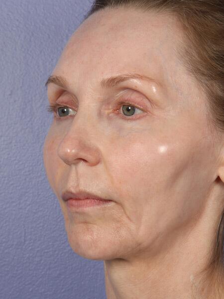 Chin & Cheek Shaping Before & After Image