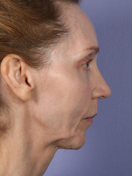 Chin & Cheek Shaping Before & After Image