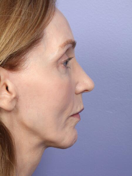 Chin & Cheek Shaping Before & After Image