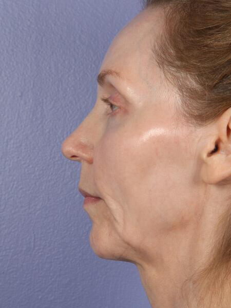 Chin & Cheek Shaping Before & After Image