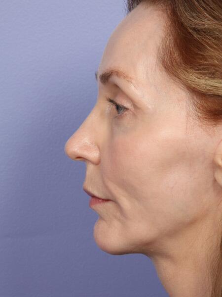 Chin & Cheek Shaping Before & After Image