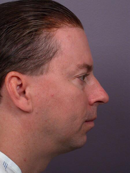 Chin & Cheek Shaping Before & After Image