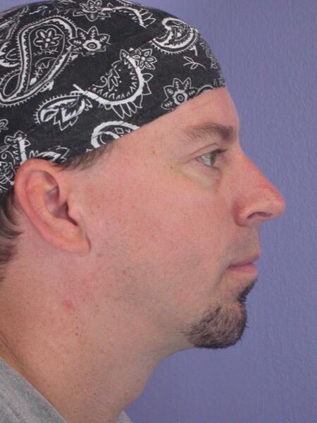 Chin & Cheek Shaping Before & After Image