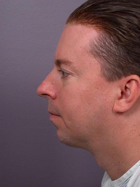 Chin & Cheek Shaping Before & After Image