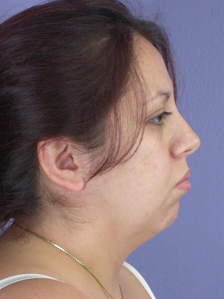 Chin & Cheek Shaping Before & After Image