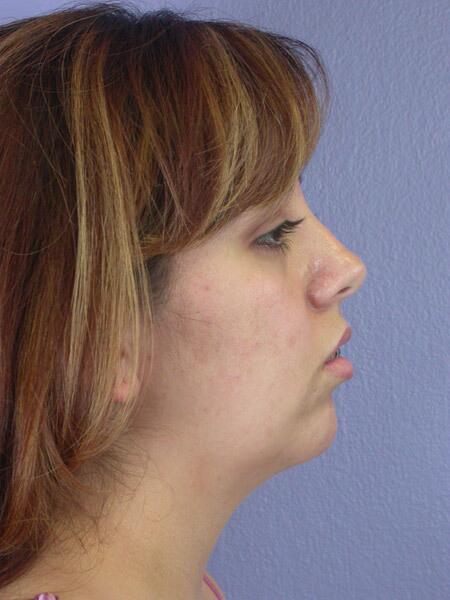 Chin & Cheek Shaping Before & After Image