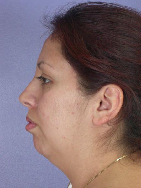 Chin & Cheek Shaping Before & After Image