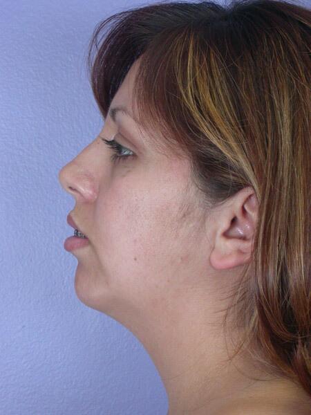 Chin & Cheek Shaping Before & After Image