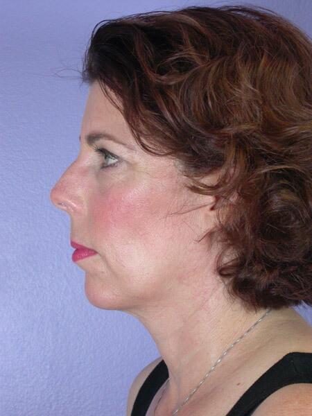 Chin & Cheek Shaping Before & After Image