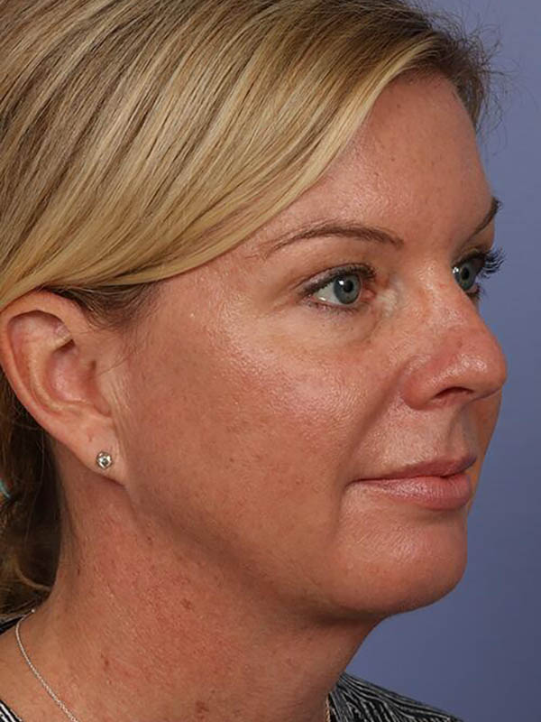 Chin & Cheek Shaping Before & After Image