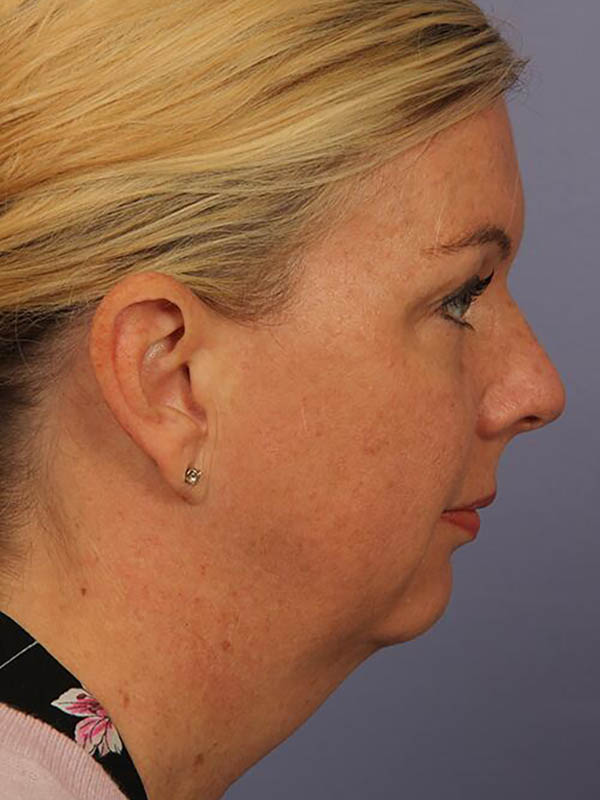 Chin & Cheek Shaping Before & After Image