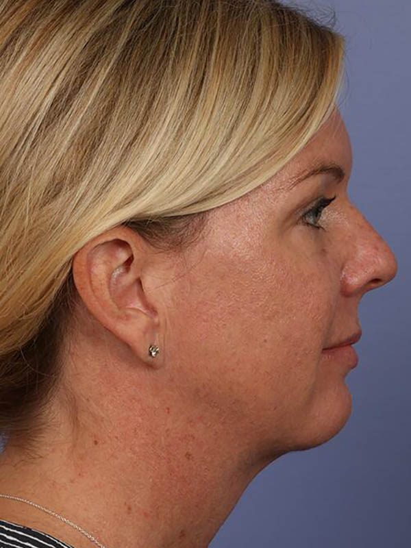 Chin & Cheek Shaping Before & After Image