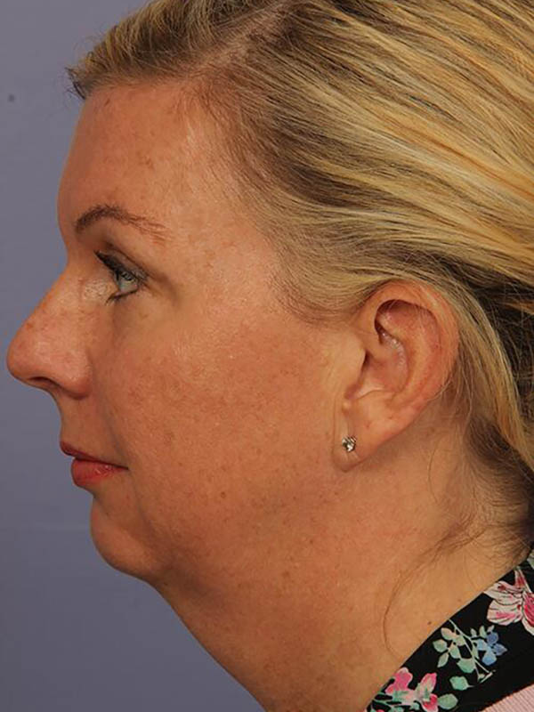 Chin & Cheek Shaping Before & After Image