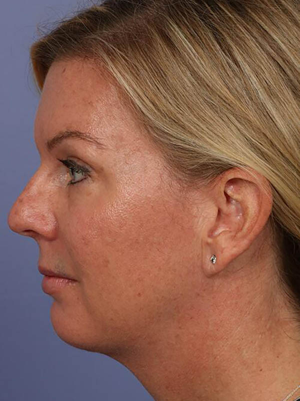 Chin & Cheek Shaping Before & After Image