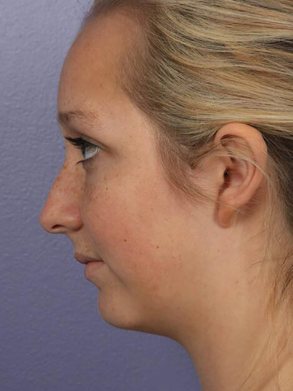 Chin & Cheek Shaping Before & After Image