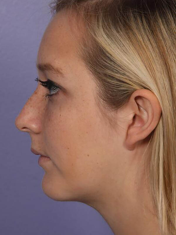 Chin & Cheek Shaping Before & After Image