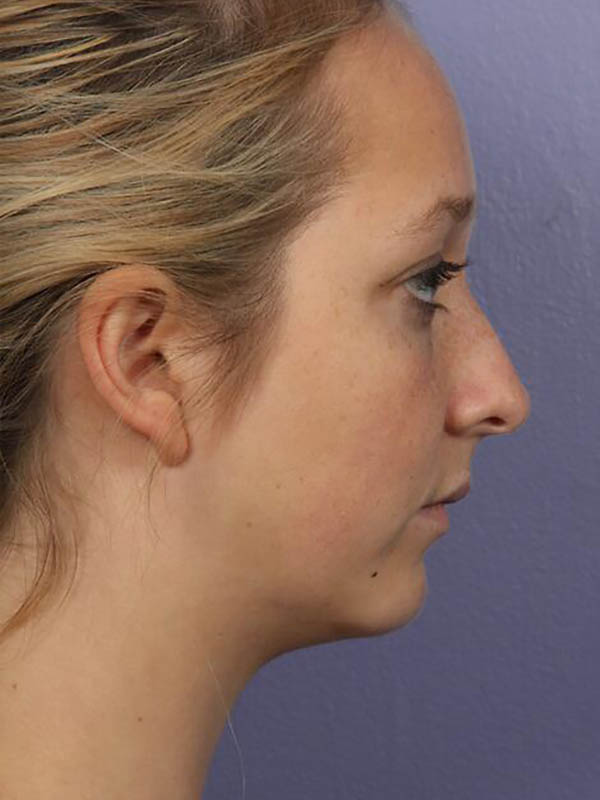 Chin & Cheek Shaping Before & After Image