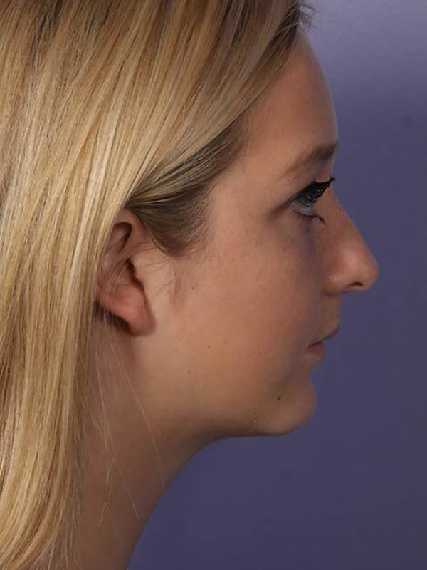 Chin & Cheek Shaping Before & After Image